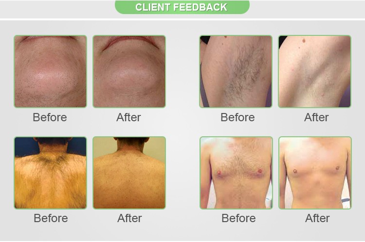 diode laser 808nm 810nm remove undesired hairs permanently.jpg