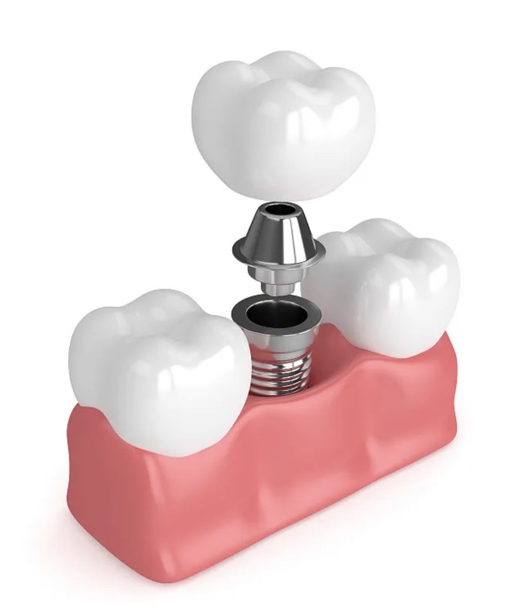 China True Dentures Implants Single All Ceramic Dentures Missing Teeth Fillings on sale