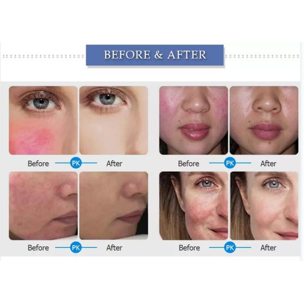 ODM Portable 980nm Diode Laser Vascular Removal Machine For Nail Fungus Therapy Treatment