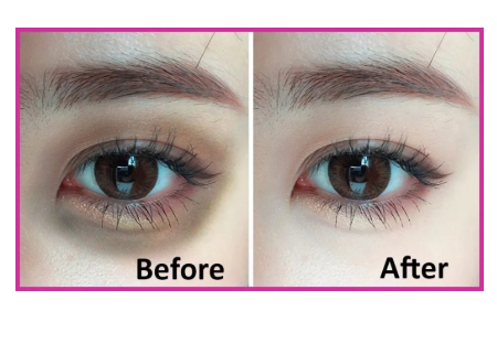 Sodium Hyaluronate Composite Solution Eyes PDRN Injection For Removing Dark Circle