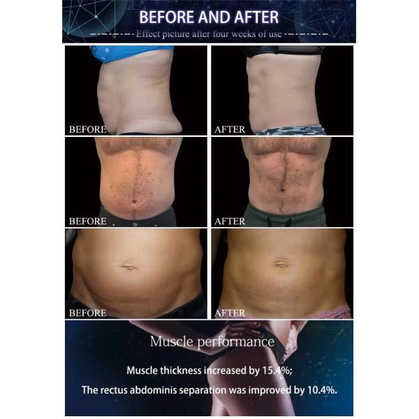 7 Tesla EMS Sculpting Machine 2800W Electromagnetic Muscle Stimulation Machine