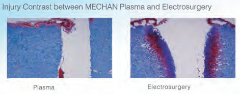 Low Temperature Plasma Surgical Instrument Probe For Hip Joint Injury Treatment