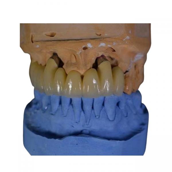 Cheap FDA PFM Crown Porcelain fused to Metal Crown for sale