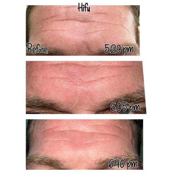 12D CRYOHIFU Hifu Facial Machine For Skin Tightening And Lifting With Hifu Ultrasound Technology