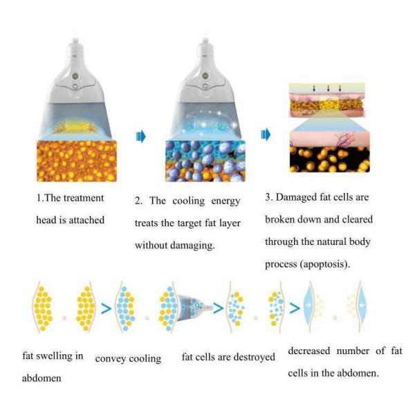 Cryolipolysis Body Slimming Machine , 360 Cryo Therapy Machine With 5 Handles