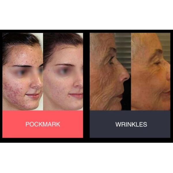 Radio Frequency Effective Body Skin Tightening Machine With Dual Frequency