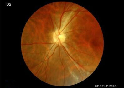 3.97 Inch TFT LCD Touch Screen Digital Fundus Camera