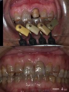 China Translucency Zirconia Crowns Multilayered Gradient Technology For Optimal Translucency And Long-Term Biocompatibility on sale