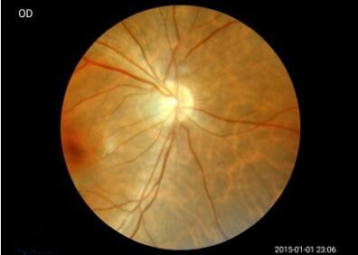 3.97 Inch TFT LCD Touch Screen Digital Fundus Camera