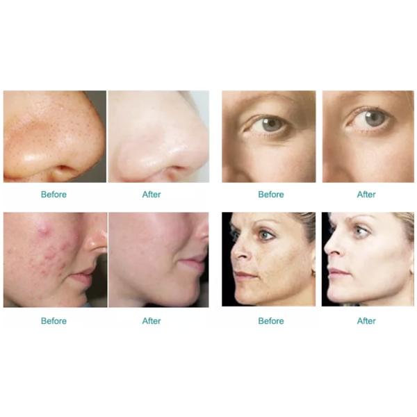 Facial Diamond Peel H2O2 Bubble Machine 500W 8 In 1 Dermabrasion