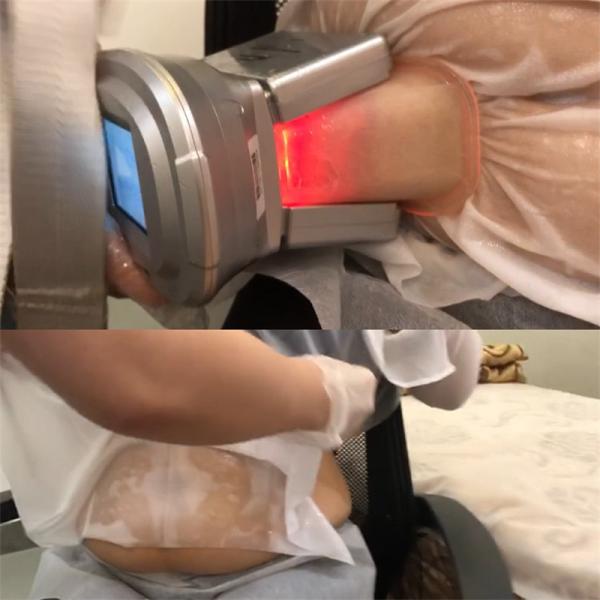 360 Cryo Cryotherapy 10kpa Liposuction Machine Body Shaping Fat Freezing Device