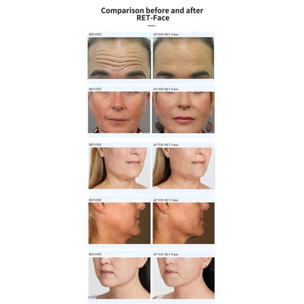 HIFE RF 2 in 1 MFACE EMS For Non Invasive Face Lift Facial Muscle Building Equipment Saggy Skin Tightening